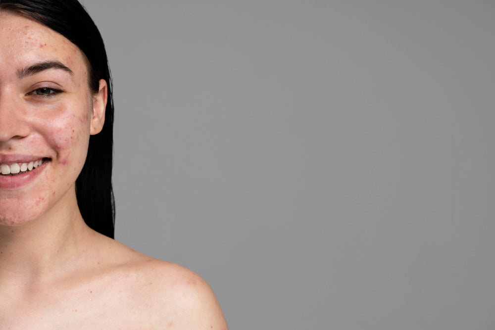 Smiling woman with stress acne on her face
