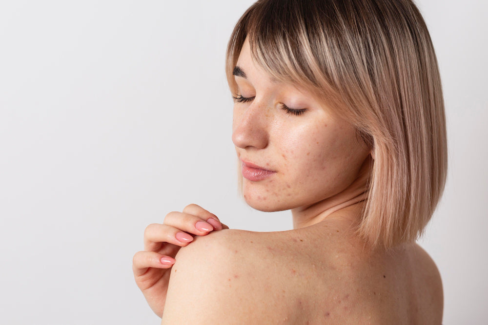 Woman looking at hormonal acne on her shoulder