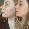 Acne Treatment Kits​