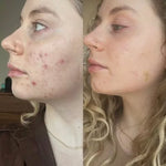 Acne Treatment Kits​