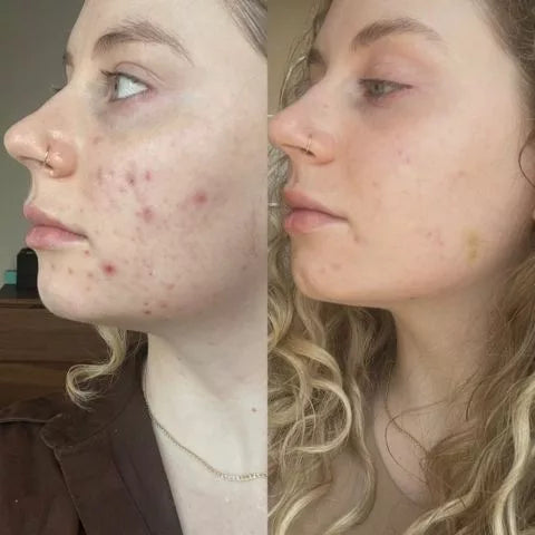Acne Treatment Kits​