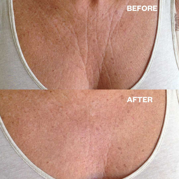 Before and after shots of womans chest after using wrinkles shminkles product